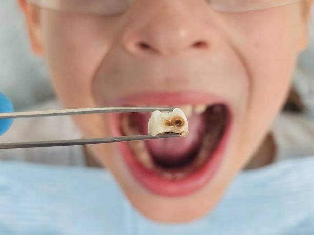 Best Knocked-Out Tooth (Avulsed Tooth) Treatment in Rice Lake, WI